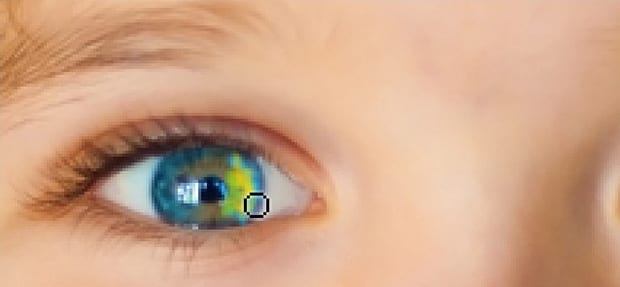 Yellow Color in Eye