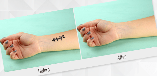 20 Celebrity Tattoo Removal Before and Afters  POPSUGAR Beauty