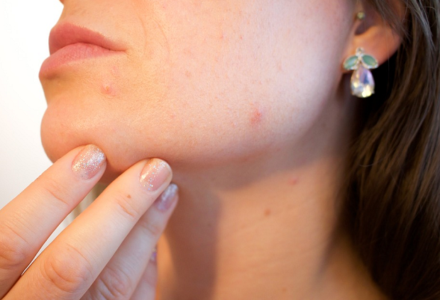 A closeup of a woman's chin with a couple of small pimples